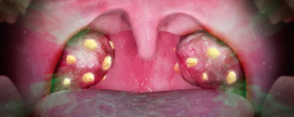  amandelstenen tonsil stones oorzaak herkennen wat zijn het